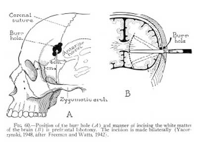 Lobotomies