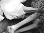 Contractured legs, Boswell Hall