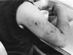 Bruised arm, Cottage 12